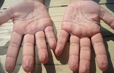 Почему кожа на пальцах морщится в воде?