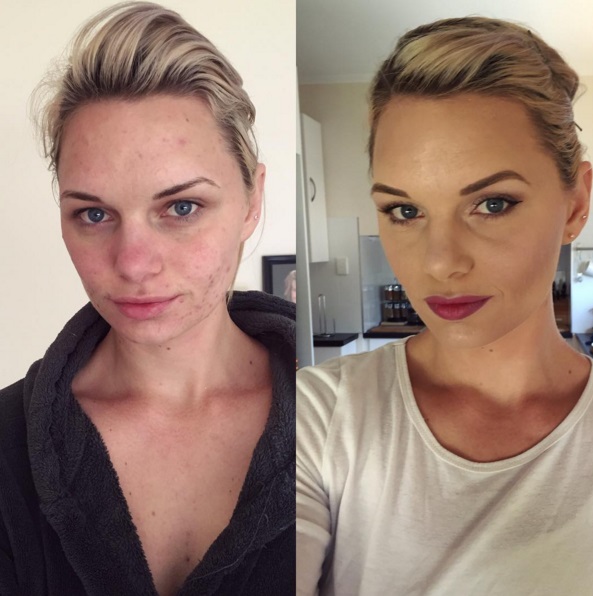 До и после: как макияж может преобразить проблемную кожу